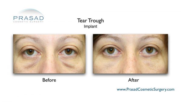 Tear Trough : treatment | Hollow under eyes - New York City