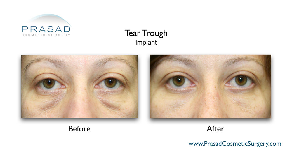 Tear Trough : treatment | Hollow under eyes - New York City