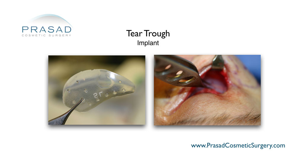 tear trough implant surgery