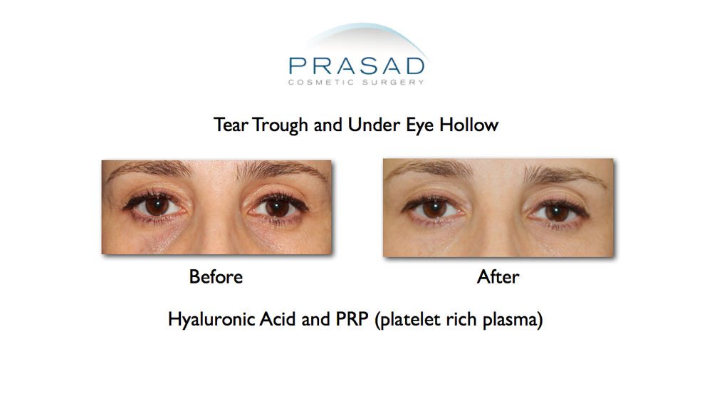 Before and after tear trough and under eye hollow results on female patient