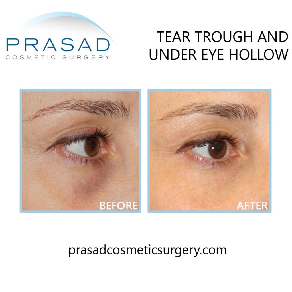 Under Eye Filler for Hollow Eyes, Tear Troughs and Eye Bags