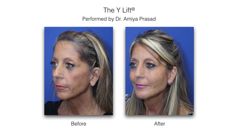 before and after liquid facelift - female patient three-quarter view