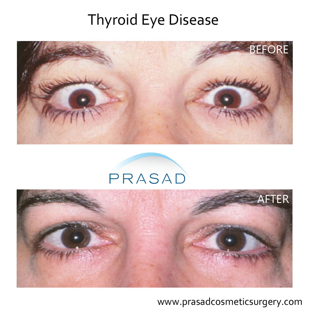 Thyroid Eye Disease Surgery/ Graves Eye Disease Surgery