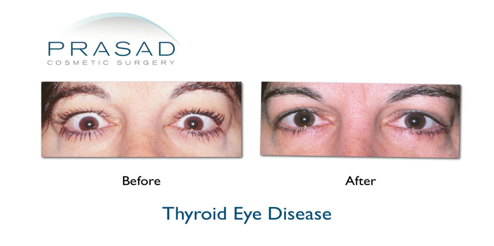 eyelid retraction surgery for thyroid eye disease before and after surgery