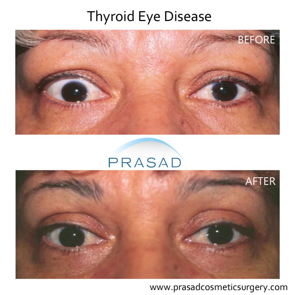 thyroid eye disease surgery before and after - female