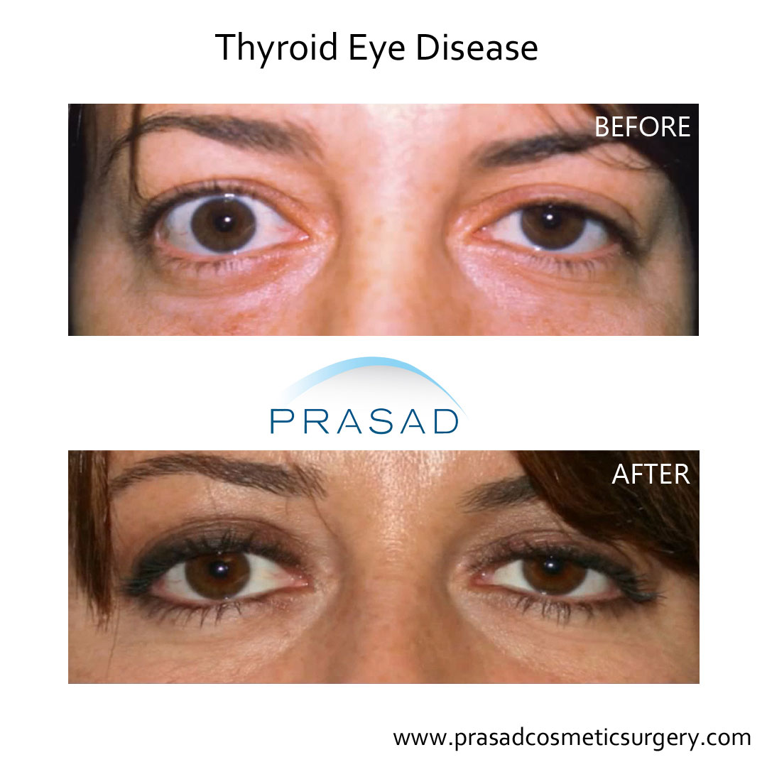 Thyroid Eye Disease Surgery Graves Eye Disease Surgery