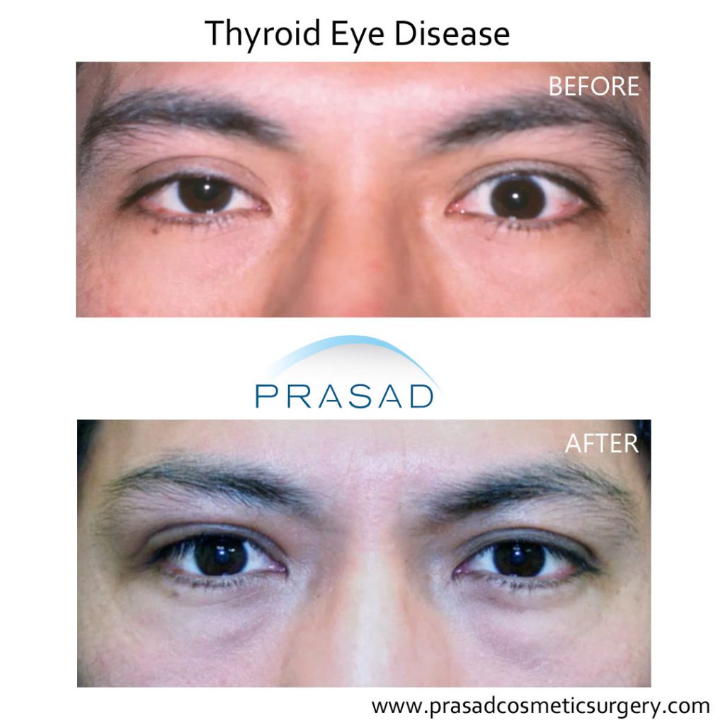 male with Thyroid Eye Disease before and after correction surgery