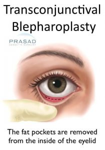 tranconjunctival blepharoplasty incision illustration