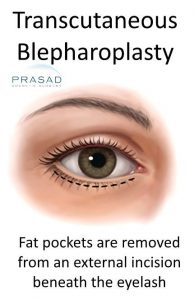 Transcutaneous Blepharoplasty incision illustration