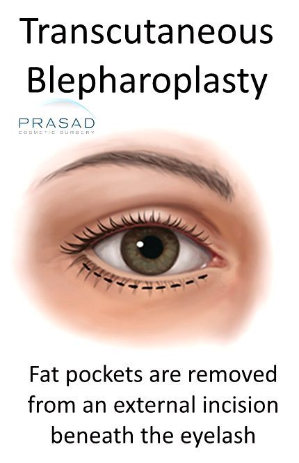 Transcutaneous-Blepharoplasty-still