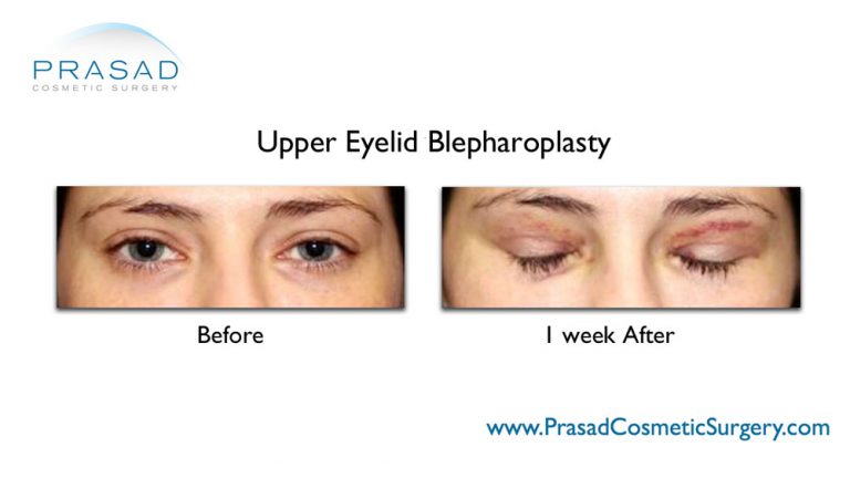 Upper Blepharoplasty / Upper Eyelid Surgery | Dr. Amiya Prasad