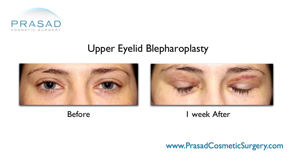 Upper Eyelid Surgery healing 1 week after surgery