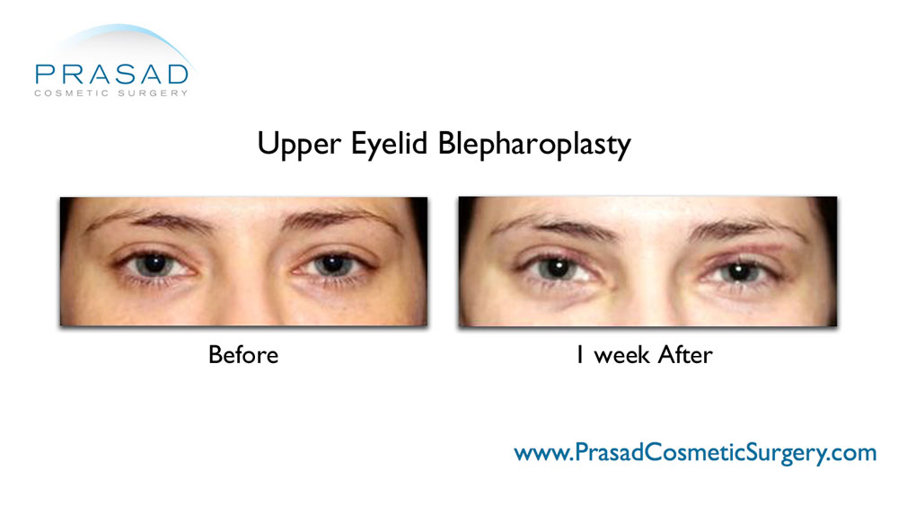 before and after Upper blepharoplasty 1 week recovery