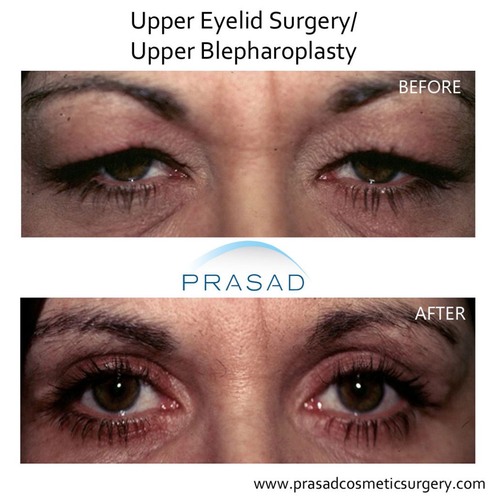 almond eye surgery patient before and after results