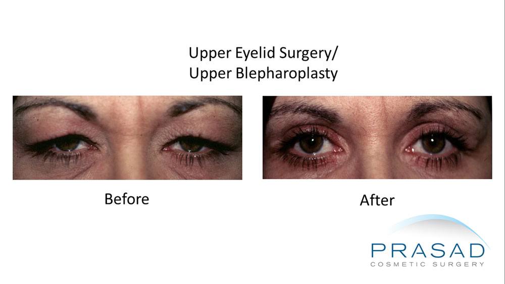 almond eye surgery before and after results
