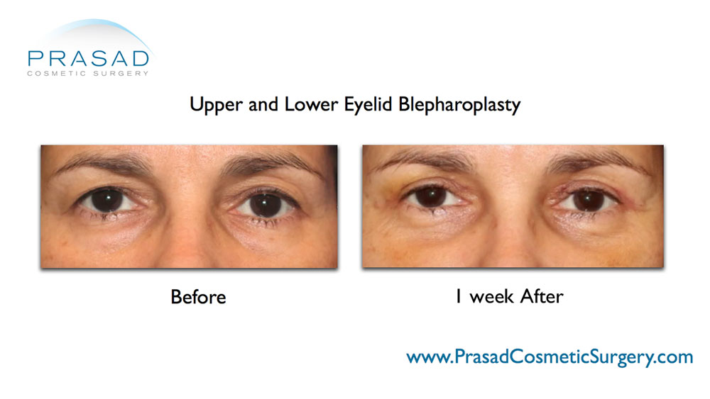 before and after lower and upper eye lift surgery recovery on female patient