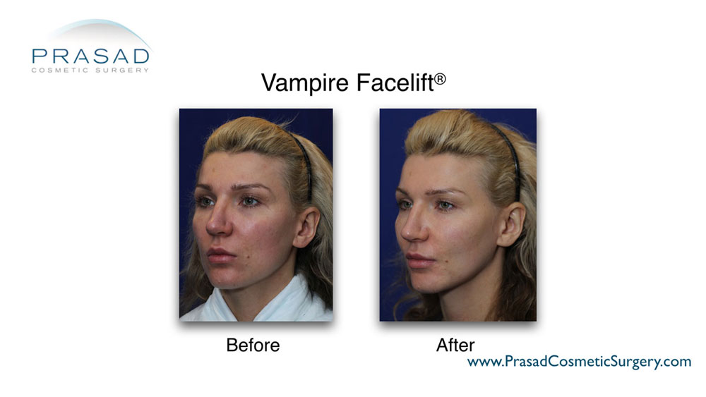 Female patient before and after vampire facelift