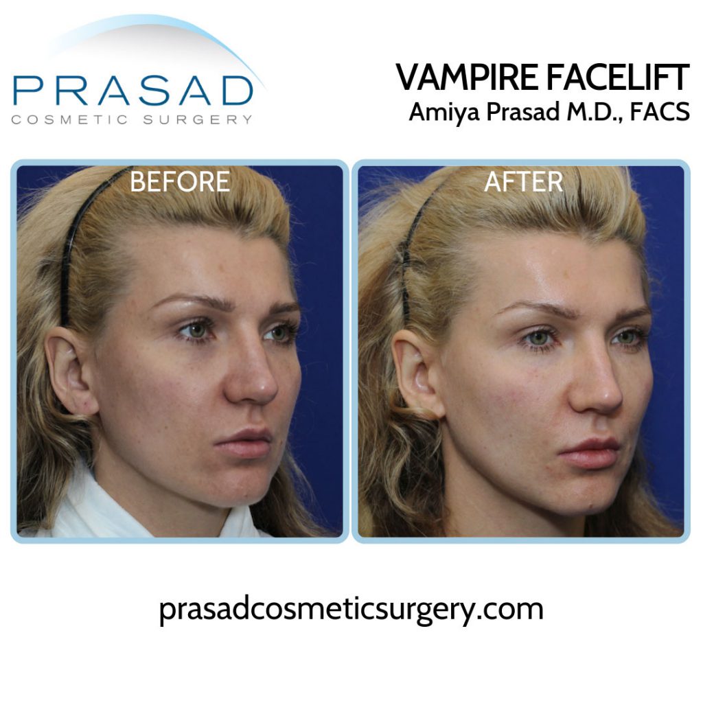 Vampire Facelift performed by Amiya Prasad MD before and after results on female patient