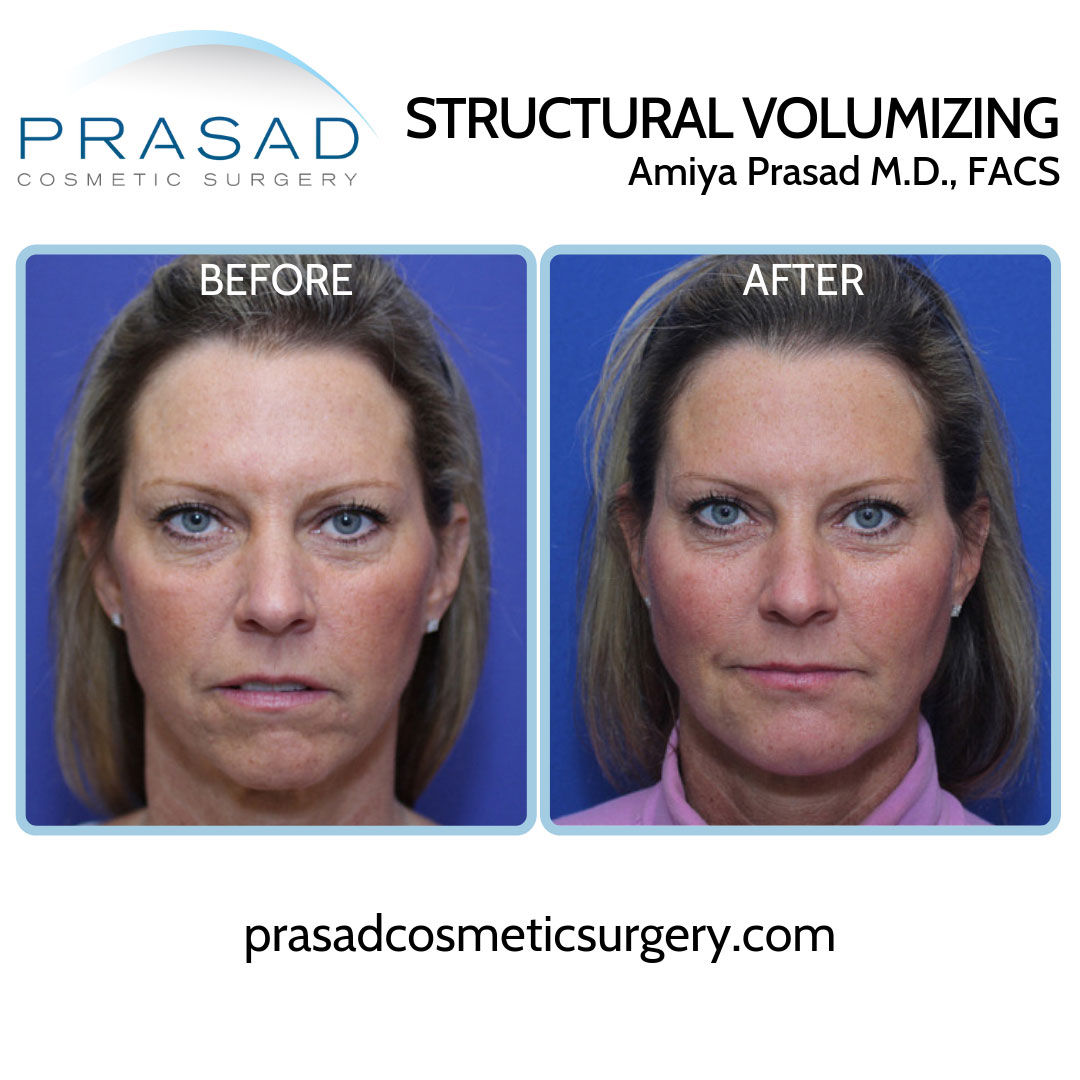 Y Lift-before and after results performed at Prasad Cosmetic Surgery