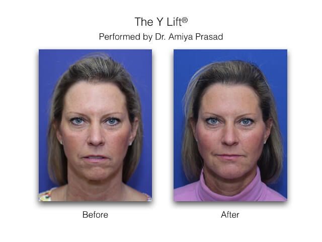 Y Lift-before and after results performed at Prasad Cosmetic Surgery