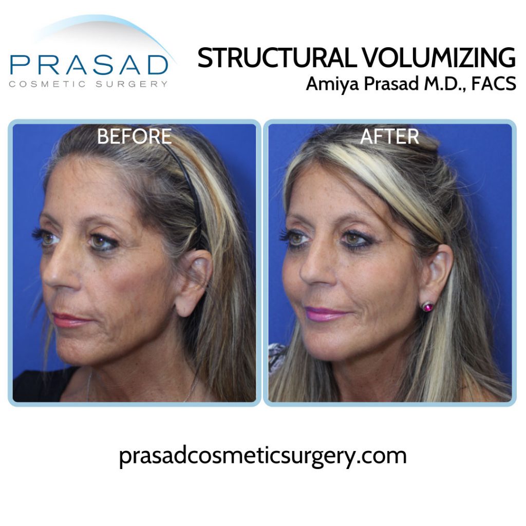 Y Lift® Non-Surgical Facelift - Dr. Amiya Prasad