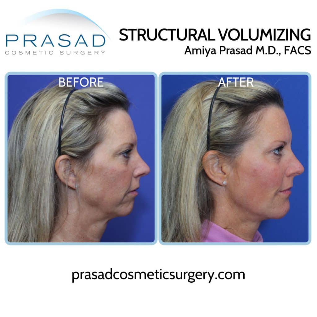 Y Lift-before and after results performed at Prasad Cosmetic Surgery - patient side view