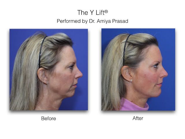 before and after Y Lift results of patient in side view