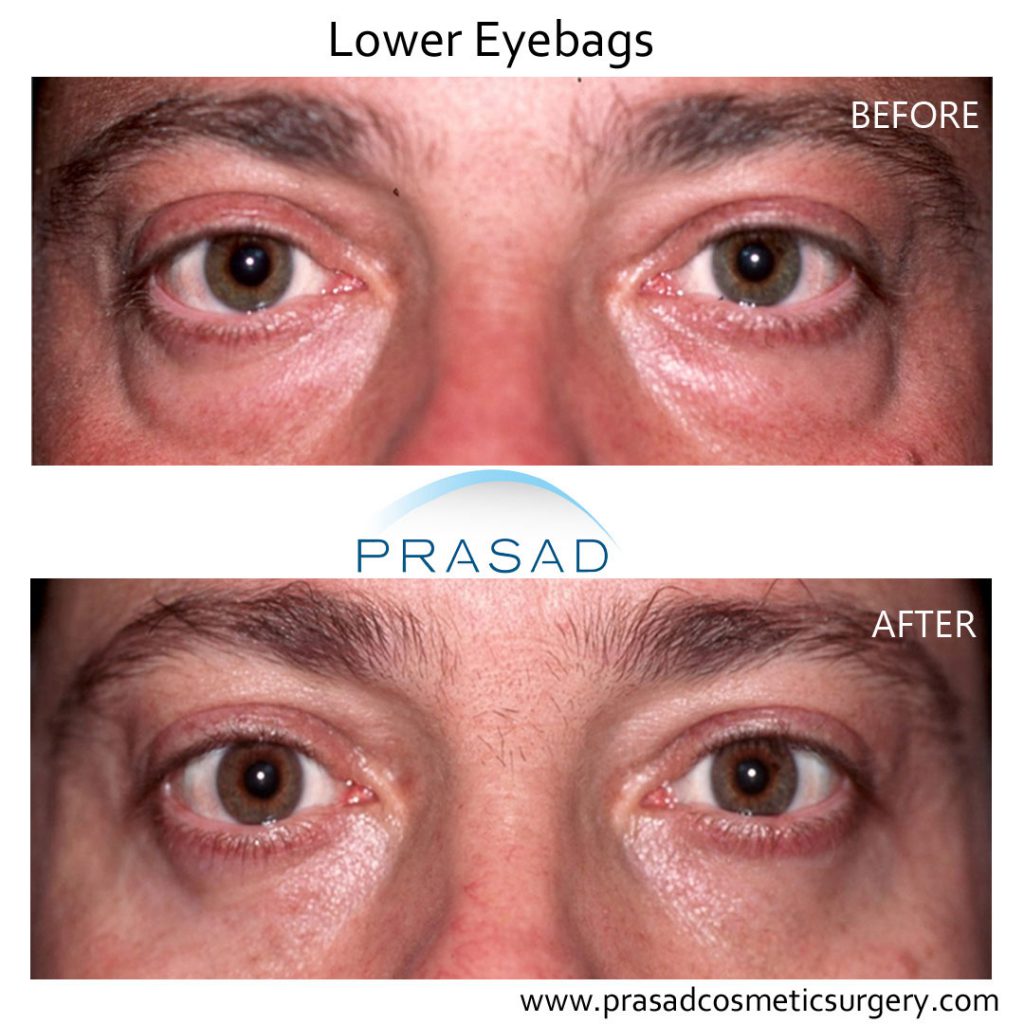 Lower Eye bags Before and After surgery - male patient