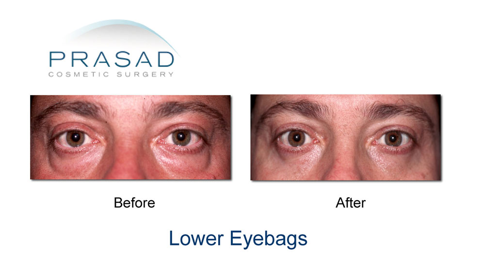 Lower Eye bags Before and After surgery - male patient