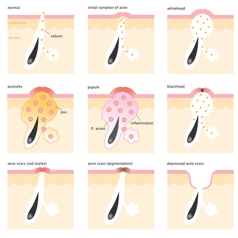 acne scars causes illustration