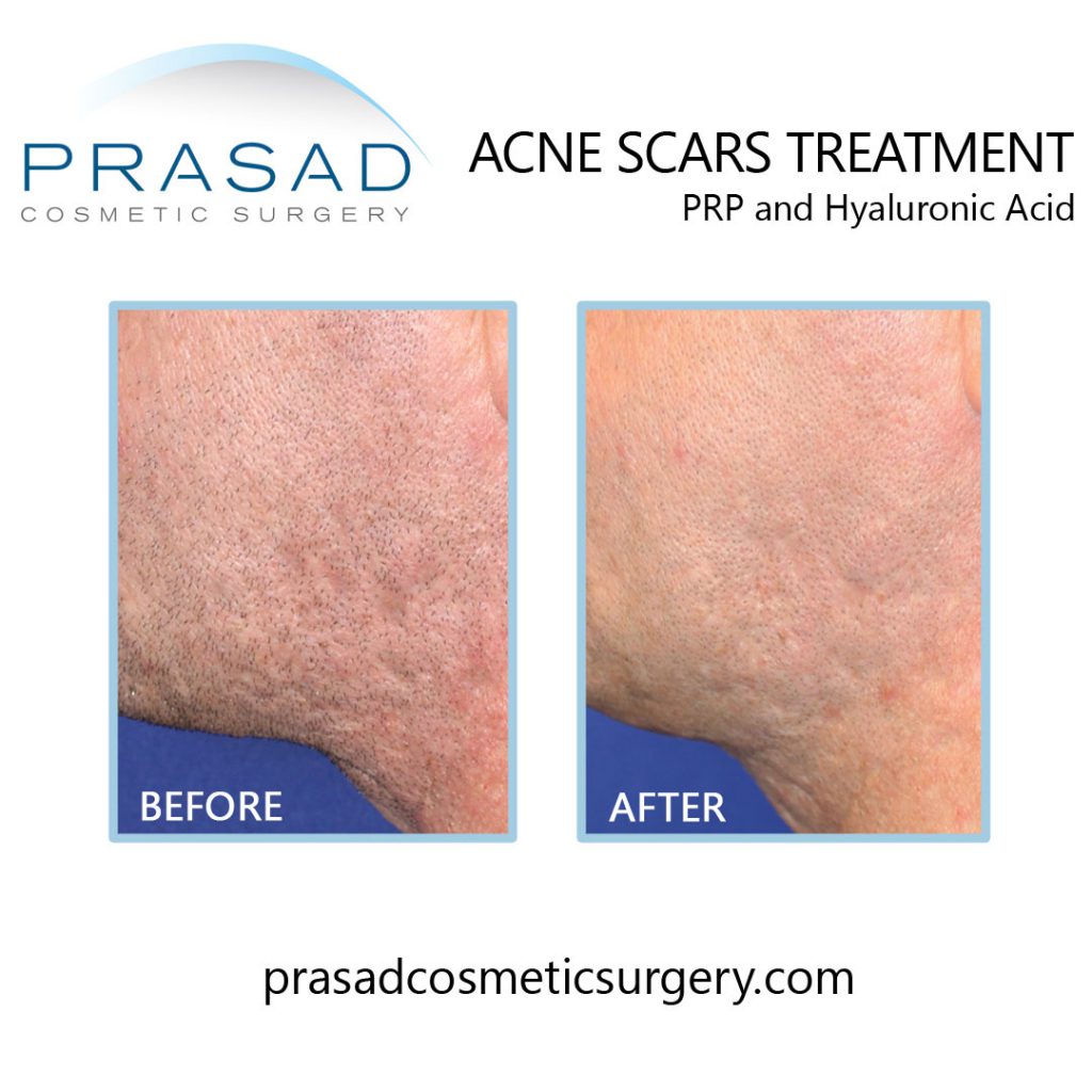 acne scars PRP treatment before and after, procedure done at Prasad Cosmetic Surgery NYC