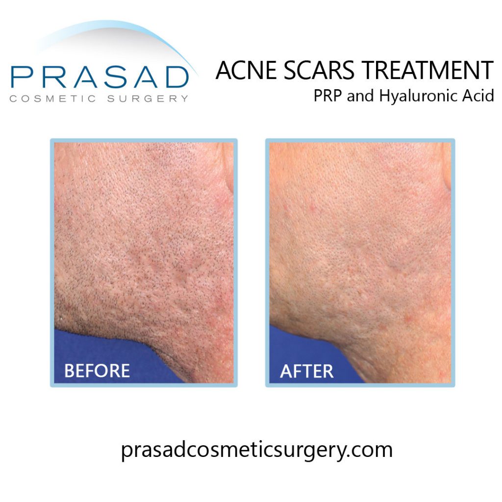 NYC Midtown Scar Treatment, Therapy, Long Island Scar Removal