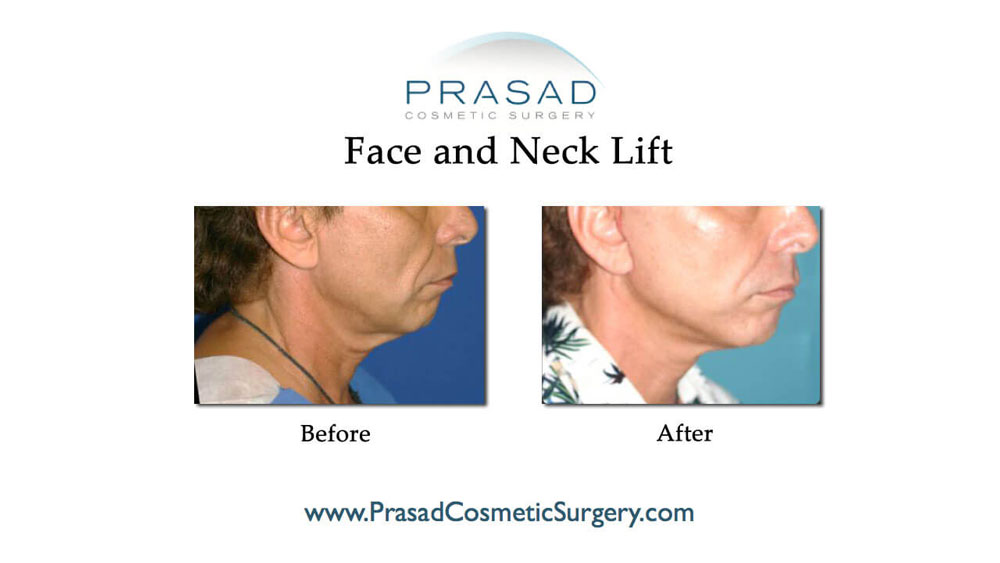 before and after results of face lifts performed by Dr Amiya Prasad USA