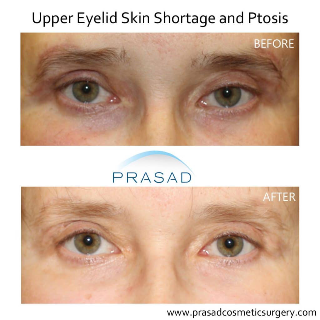 Before and after upper eyelid skin shortage and ptosis