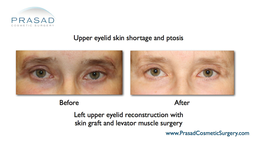 Before and after upper eyelid skin shortage and ptosis