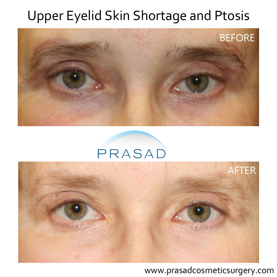 Can Upper Blepharoplasty Go Wrong? | Dr. Prasad Blog