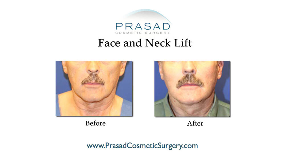 before and after face and neck lift by Dr Prasad