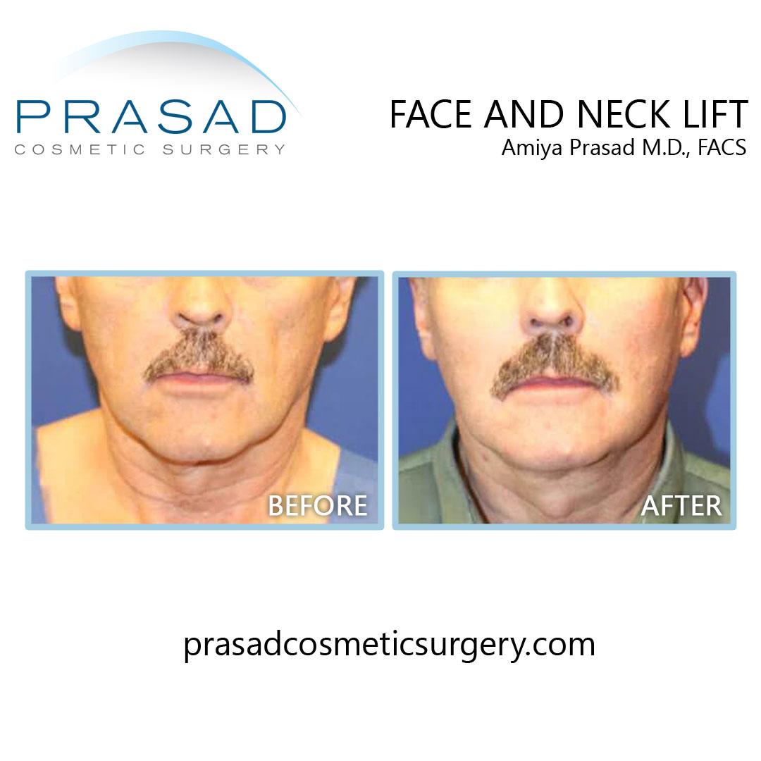 before and after facelift best results on male patient