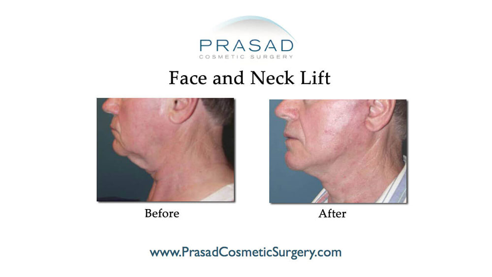 before and after best plastic surgery in NYC