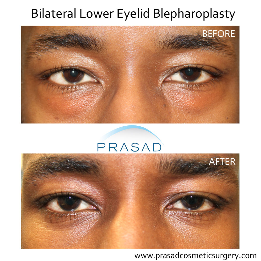 lower eyelid surgery before and after male dark skin patient