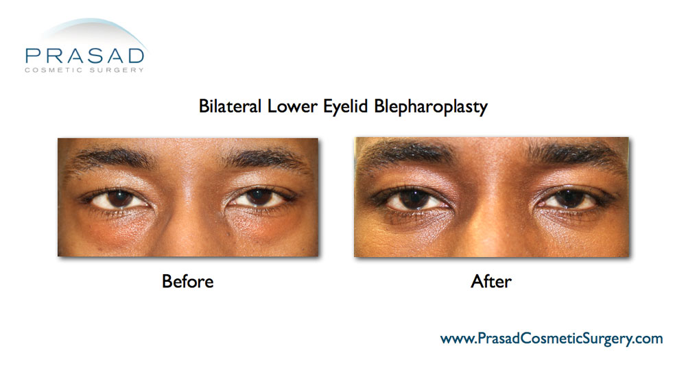 lower eye lift before and after male dark skin patient