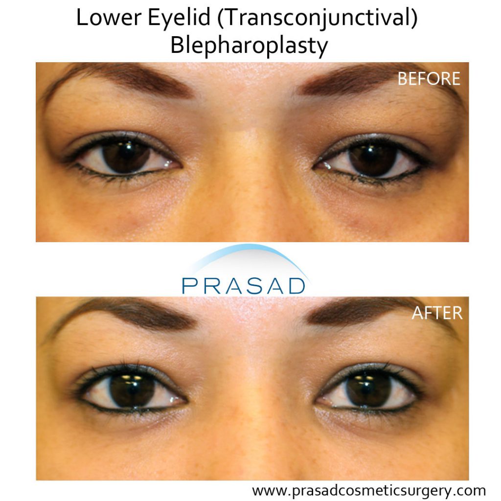 lower blepharoplasty recovery photos before and after