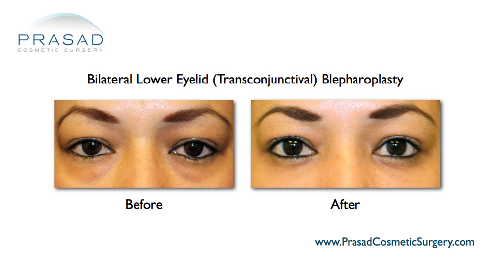 lower blepharoplasty recovery photos