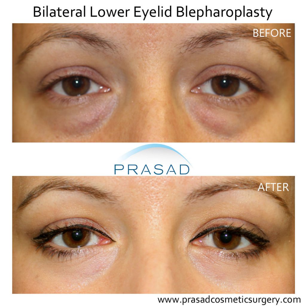 6 Benefits of Ultherapy For Under the Eyes - Radiance Skincare & Laser  Medspa