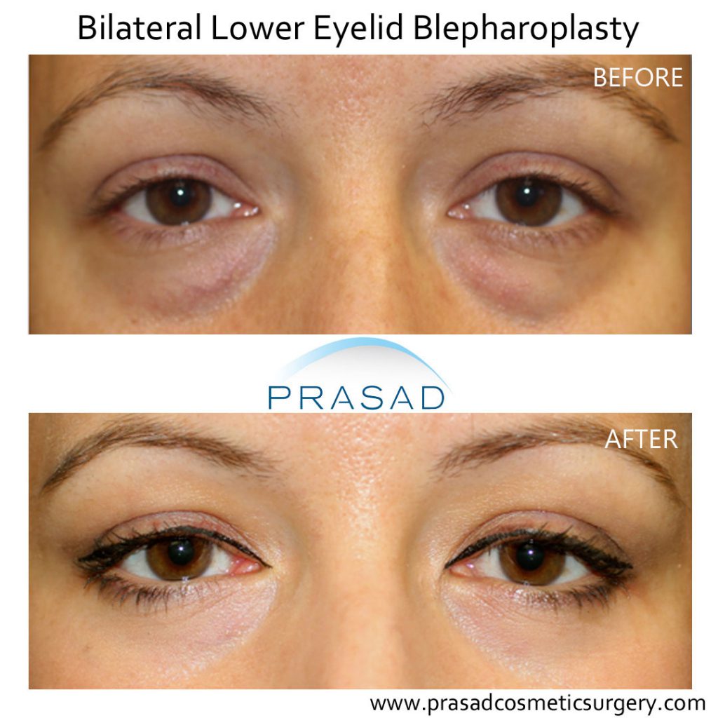 female under eye bags surgery before and after