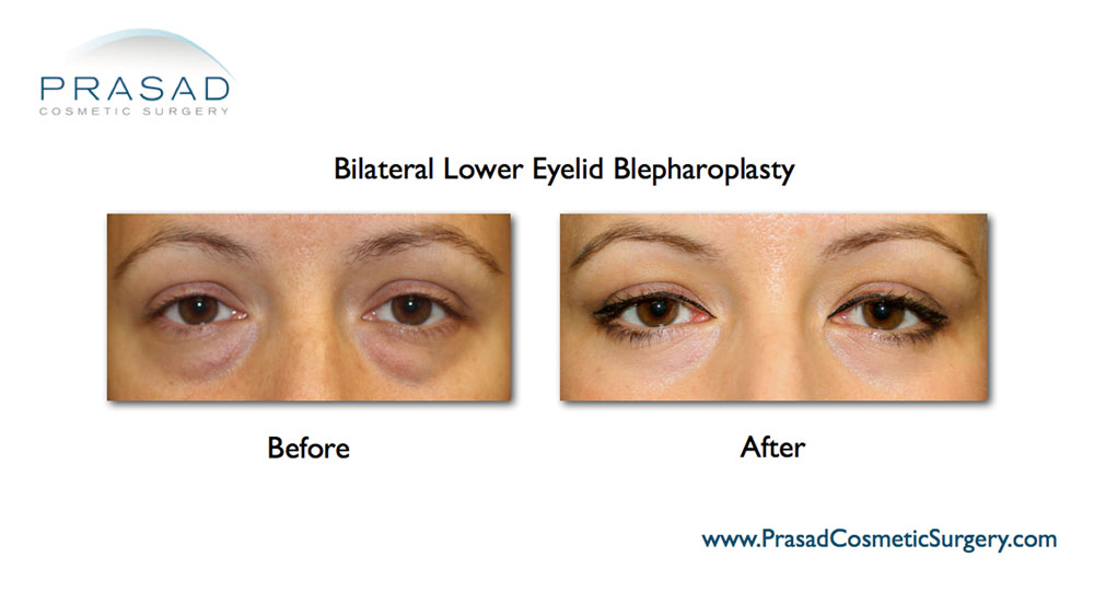 before and after lower eyelid blepharoplasty female patient