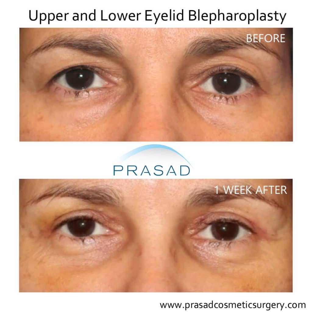 upper and lower eyelid blepharoplasty before and after 1 week recovery
