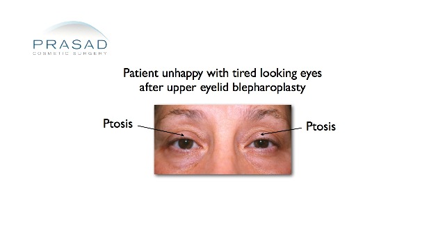ptosis after upper eyelid surgery