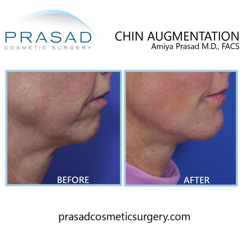 chin augmentation filler before and after results