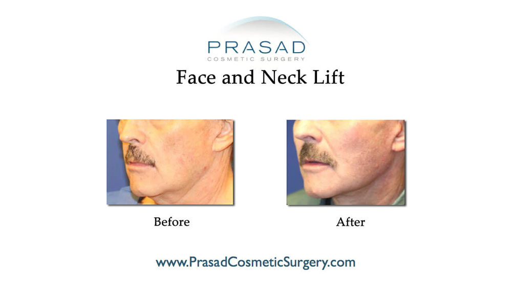 lower facelift surgery before and after results